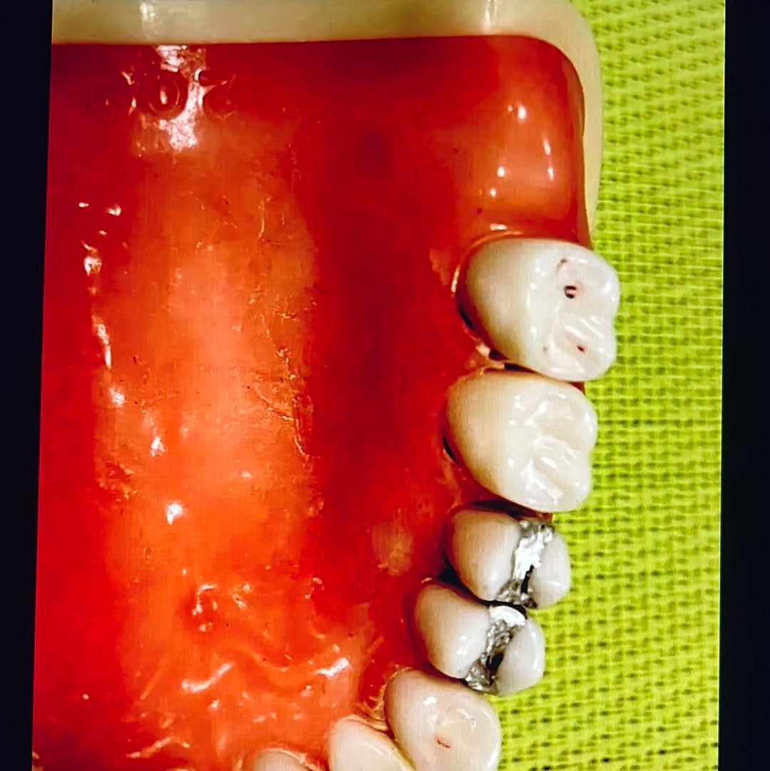 KILGORE NISSIN Soft Gum 28 Teeth For Operative Crown & bridge Ebay Inv $200